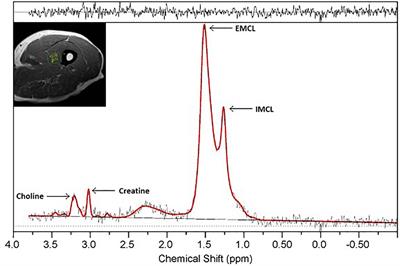 Contribution of Intramyocellular Lipids to Decreased Computed Tomography Muscle Density With Age